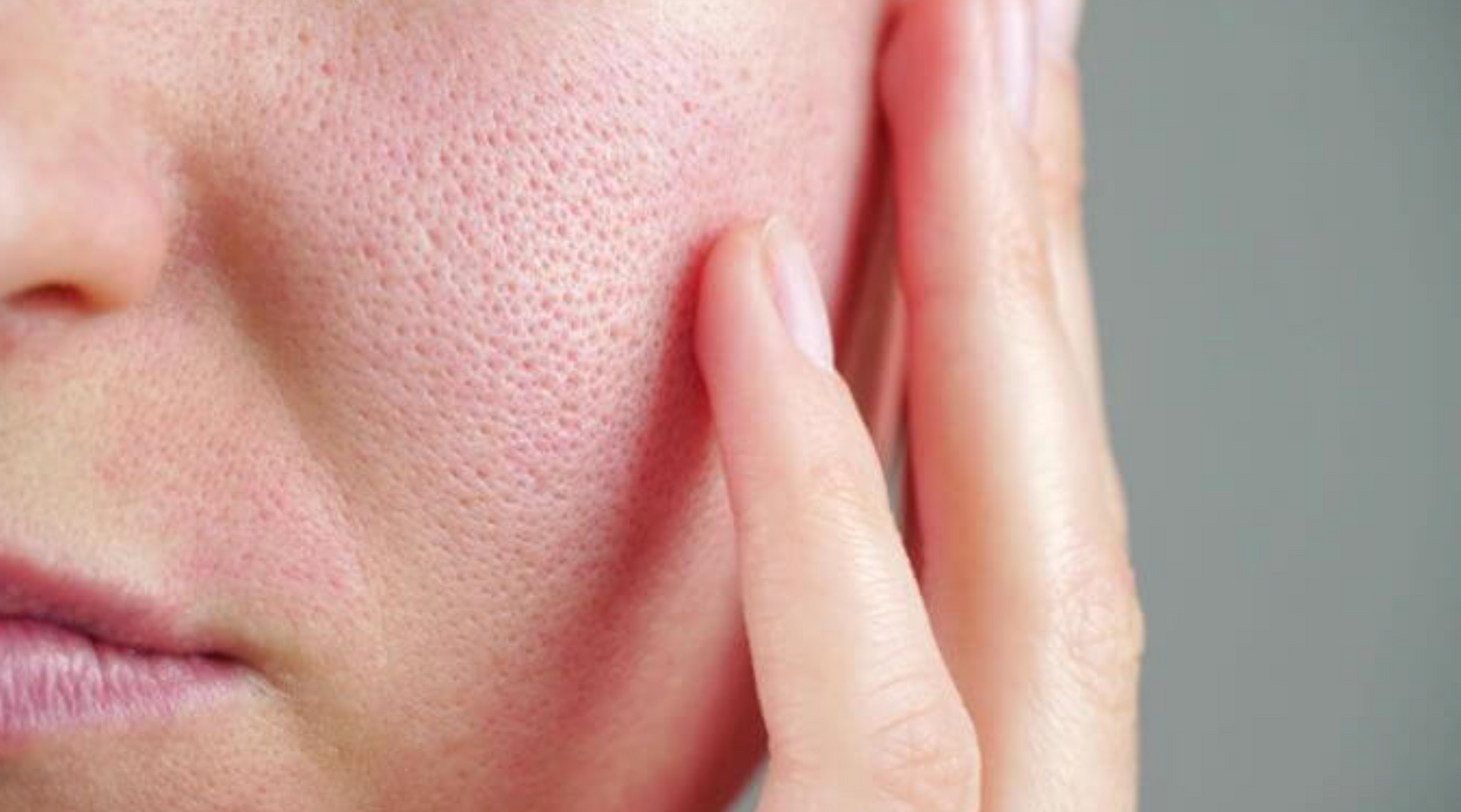 Your Guide to Minimising Pores and Achieving Flawless Skin